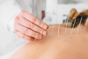 HU disponibiliza sessões de acupuntura e promove mais qualidade de vida