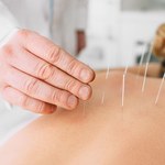 HU disponibiliza sessões de acupuntura e promove mais qualidade de vida
