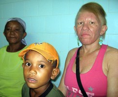 Quilombolas albinos recebem assistência médica