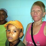 Quilombolas albinos recebem assistência médica