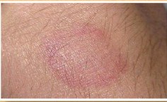 Áreas avermelhadas com diminuição de pêlos, com alteração da sensibilidade ao calor, à dor e ao tato.