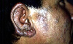 Hanseníase acomete também a face