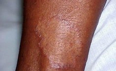 Lesões na pele provocadas pela Hanseníase