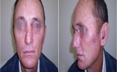 Paciente tratado no HU