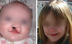 Crianças com lábio leporino