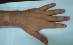 Aspecto da lesão linfo cutânea na mão e braço do proprietario do gato, ambos portandores de esporotricose aqui em tratamento ha seis meses