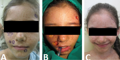 Pesquisa desenvolve métodos de cicatrização para tratamento de câncer de pele
