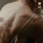 Pandemia de Covid-19 prejudica diagnóstico da hanseníase no país